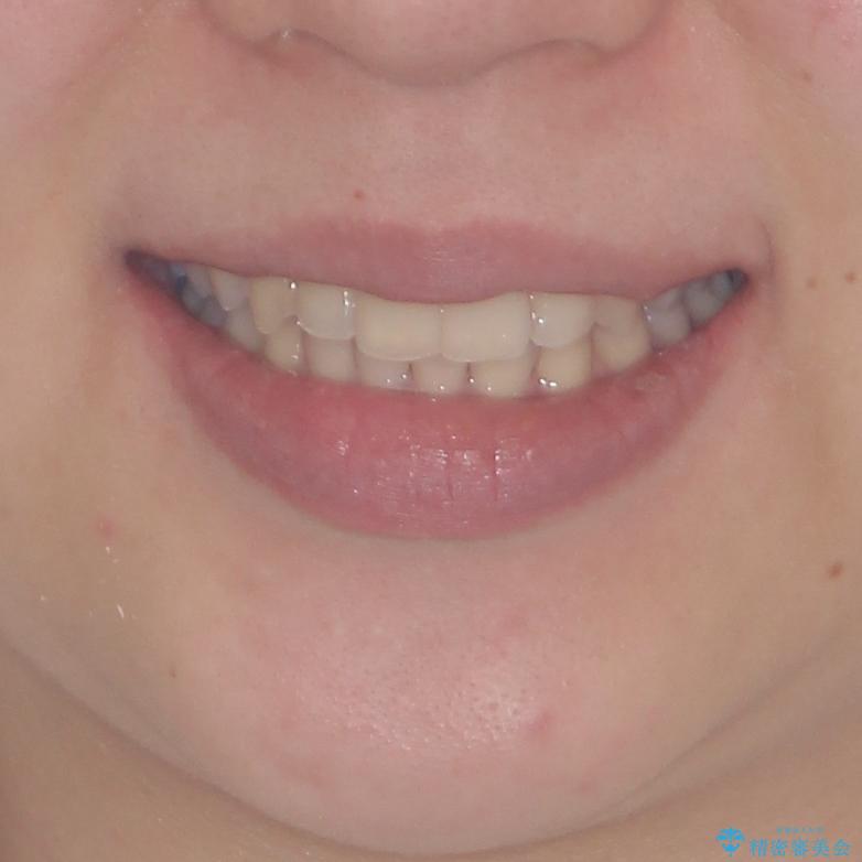 骨格的に左右にずれいている　前歯のデコボコをインビザラインで解消の治療後（顔貌）