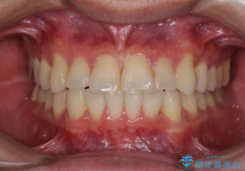 冷たいものがしみて奥歯が痛い 気になる歯並びも治したの症例 治療後