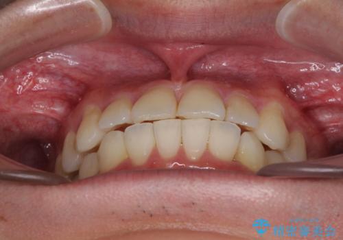 冷たいものがしみて奥歯が痛い 気になる歯並びも治したの治療後