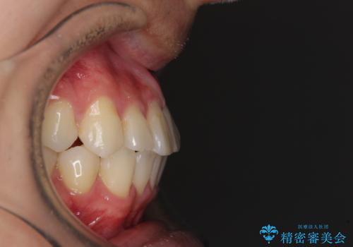 冷たいものがしみて奥歯が痛い 気になる歯並びも治したの治療後