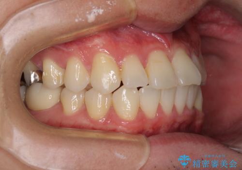 冷たいものがしみて奥歯が痛い 気になる歯並びも治したの治療後