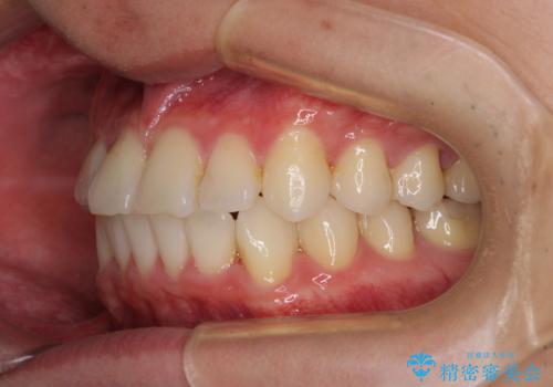 冷たいものがしみて奥歯が痛い 気になる歯並びも治したの治療後