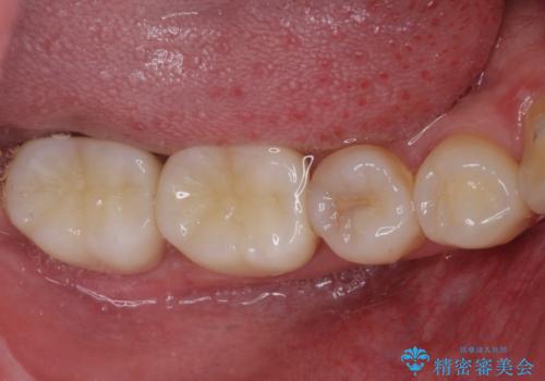 冷たいものがしみて奥歯が痛い 気になる歯並びも治したの治療後