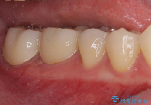 冷たいものがしみて奥歯が痛い 気になる歯並びも治したの治療後