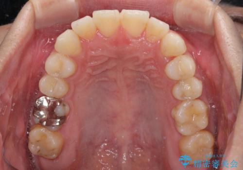 冷たいものがしみて奥歯が痛い 気になる歯並びも治したの治療後