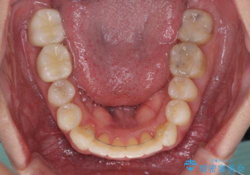 冷たいものがしみて奥歯が痛い 気になる歯並びも治したの治療後