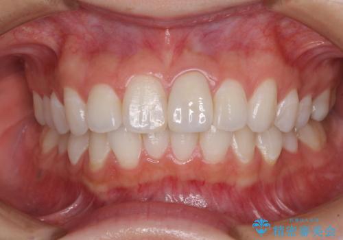 出っ歯に仕上がってしまった前歯 セラミッククラウンの作り替えの治療後