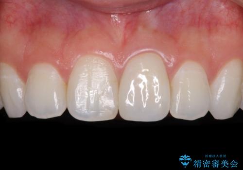 出っ歯に仕上がってしまった前歯 セラミッククラウンの作り替えの治療後