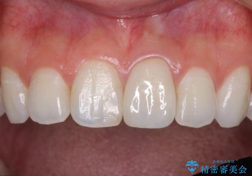 出っ歯に仕上がってしまった前歯 セラミッククラウンの作り替えの治療後