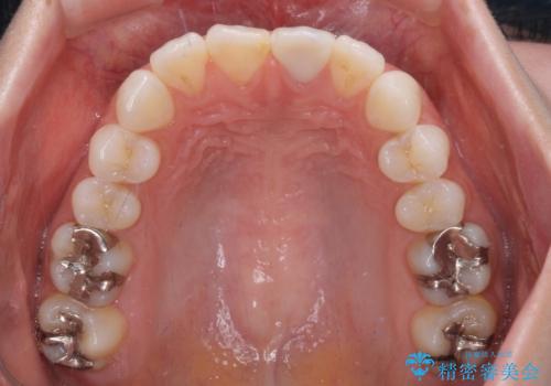 出っ歯に仕上がってしまった前歯 セラミッククラウンの作り替えの治療後