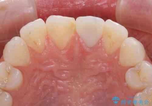 出っ歯に仕上がってしまった前歯 セラミッククラウンの作り替えの症例 治療後