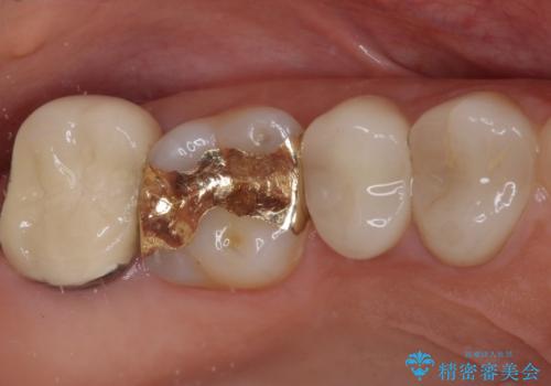 強い咬み合わせでむし歯が悪化　ゴールドインレーによるむし歯治療