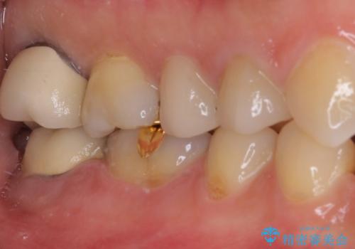 強い咬み合わせでむし歯が悪化　ゴールドインレーによるむし歯治療の治療後