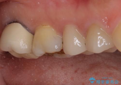 強い咬み合わせでむし歯が悪化　ゴールドインレーによるむし歯治療の治療後