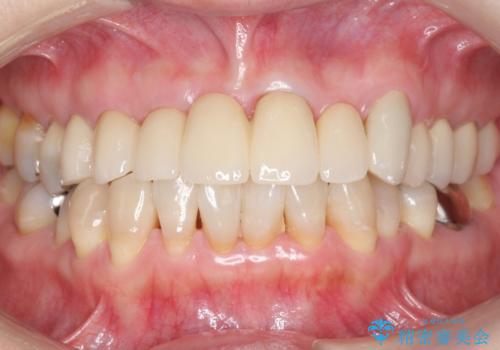前歯のブリッジの下が虫歯 ブリッジのやりかえの症例 治療後
