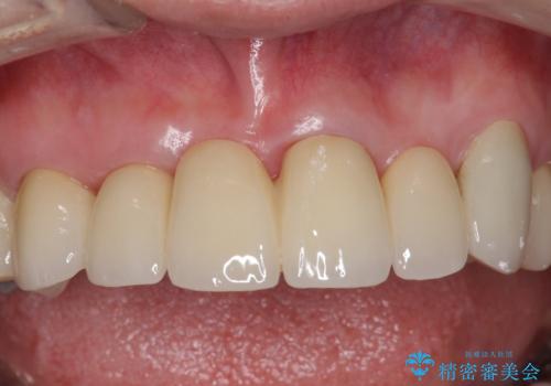 前歯のブリッジの下が虫歯 ブリッジのやりかえの治療後
