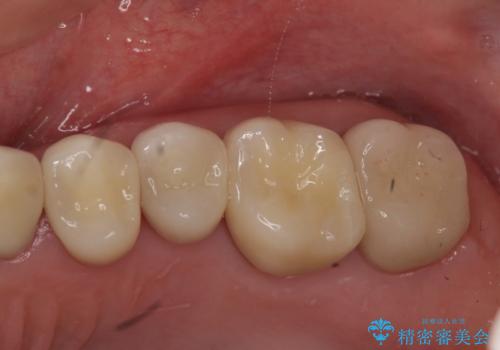 奥歯の被せ物のやり直し　精密根管治療の症例 治療後