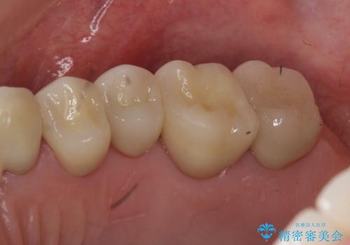 奥歯の被せ物のやり直し 精密根管治療の治療後