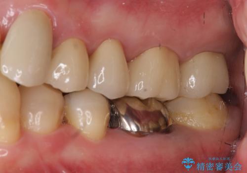 奥歯の被せ物のやり直し 精密根管治療の治療後