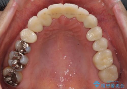 前歯のブリッジの下が虫歯 ブリッジのやりかえの治療後