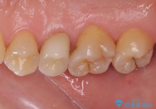 神経が死んで変色した歯 根管治療とオールセラミッククラウンの治療後