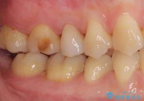 神経が死んで変色した歯 根管治療とオールセラミッククラウンの治療後