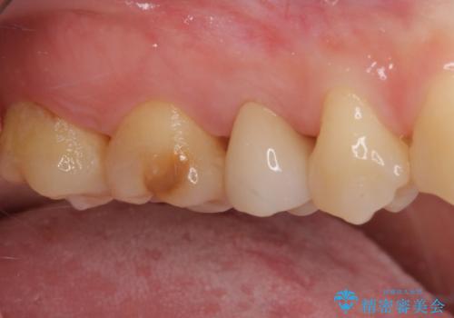 神経が死んで変色した歯 根管治療とオールセラミッククラウンの治療後