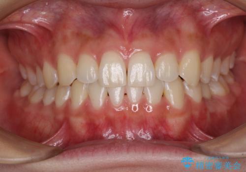 乳歯を抜いてインプラントに 咬み合わせ改善のインビザライン矯正の治療後