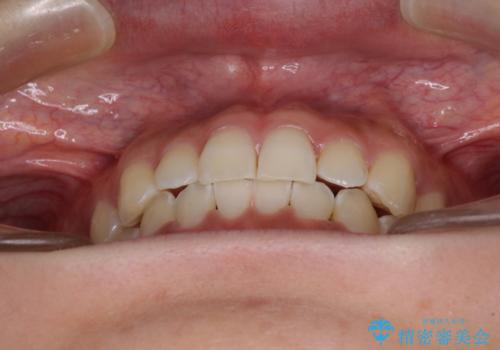 乳歯を抜いてインプラントに　咬み合わせ改善のインビザライン矯正の治療後