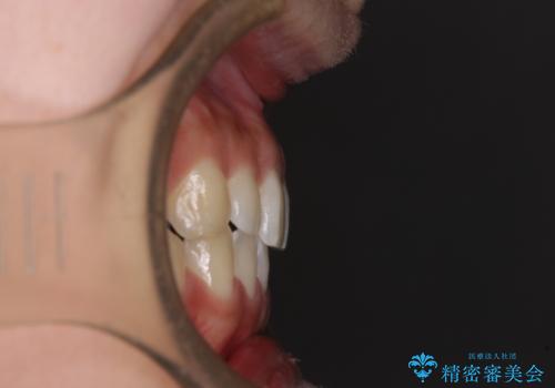 乳歯を抜いてインプラントに 咬み合わせ改善のインビザライン矯正の治療後