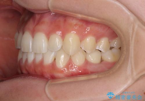 乳歯を抜いてインプラントに 咬み合わせ改善のインビザライン矯正の治療後