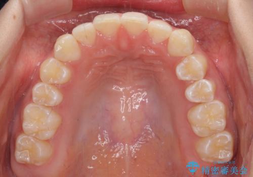 乳歯を抜いてインプラントに 咬み合わせ改善のインビザライン矯正の治療後