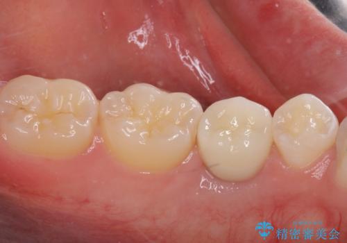 乳歯を抜いてインプラントに 咬み合わせ改善のインビザライン矯正の治療後