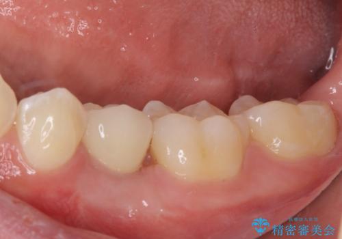 乳歯を抜いてインプラントに 咬み合わせ改善のインビザライン矯正の治療後