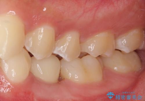 乳歯を抜いてインプラントに 咬み合わせ改善のインビザライン矯正の治療後