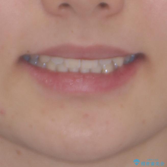 乳歯を抜いてインプラントに　咬み合わせ改善のインビザライン矯正の治療後（顔貌）
