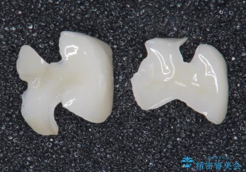 奥歯にフロスを通すと臭い 30代女性の治療中