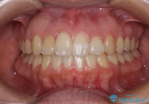 妊娠中に治療を終了 ワイヤー装置によるスピーディーな矯正治療