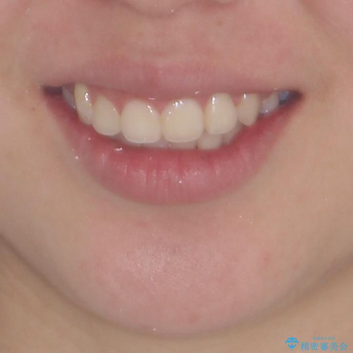 著しい叢生と顎骨のズレ　ワイヤー装置による抜歯矯正の治療後（顔貌）