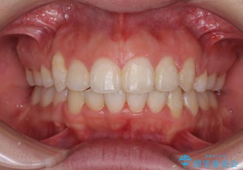 著しい叢生と顎骨のズレ　ワイヤー装置による抜歯矯正の症例 治療後