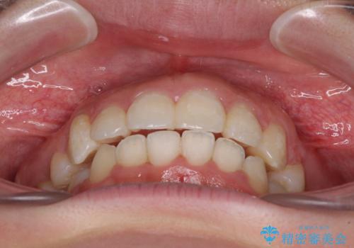 著しい叢生と顎骨のズレ ワイヤー装置による抜歯矯正の治療後