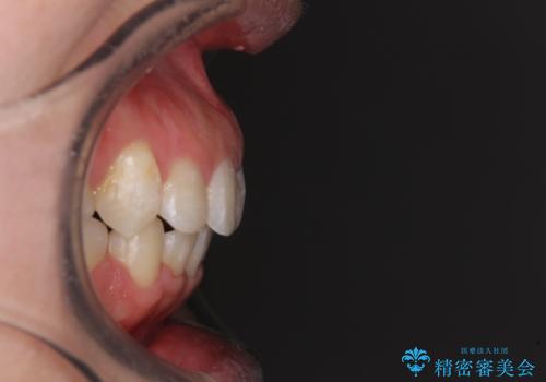 著しい叢生と顎骨のズレ ワイヤー装置による抜歯矯正の治療後