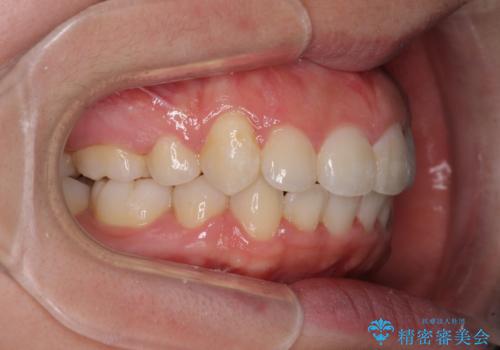 著しい叢生と顎骨のズレ　ワイヤー装置による抜歯矯正の治療後