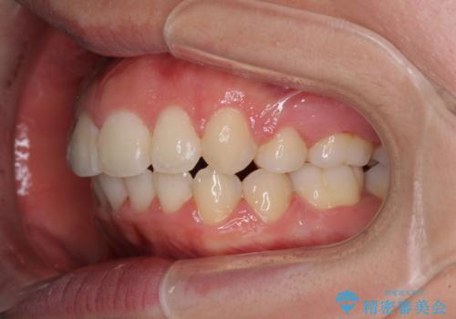 著しい叢生と顎骨のズレ ワイヤー装置による抜歯矯正の治療後