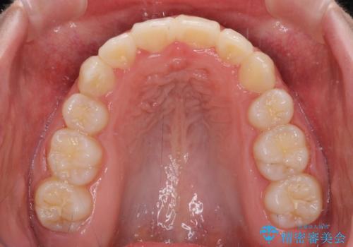 著しい叢生と顎骨のズレ ワイヤー装置による抜歯矯正の治療後