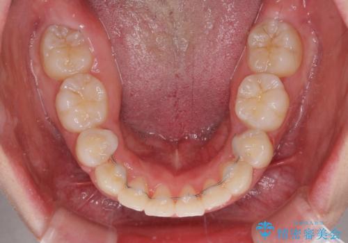 著しい叢生と顎骨のズレ ワイヤー装置による抜歯矯正の治療後