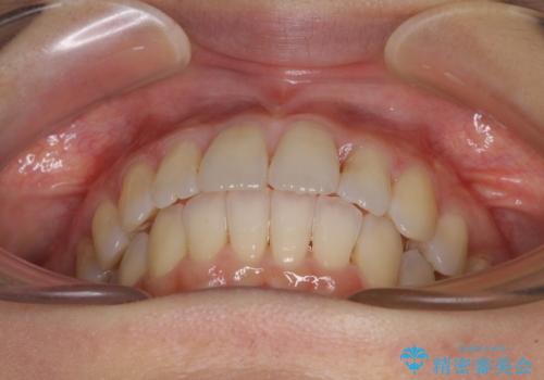 短期間で仕上げたい ワイヤーでの非抜歯矯正の治療後