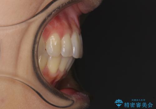 短期間で仕上げたい ワイヤーでの非抜歯矯正の治療後