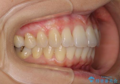 短期間で仕上げたい ワイヤーでの非抜歯矯正の治療後