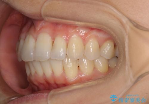 短期間で仕上げたい ワイヤーでの非抜歯矯正の治療後